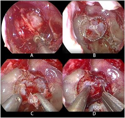 Skull base reconstruction using in situ bone flap in patients with pituitary adenomas treated by endoscopic endonasal approach